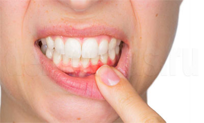 Как ставят зубные импланты - этапы и сроки имплантации